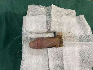 Tăng kích thước dương vật bằng tấm độn sinh học megaderm, đường mổ ở mu, khách hàng 34 tuổi, Bắc Ninh - ca 163