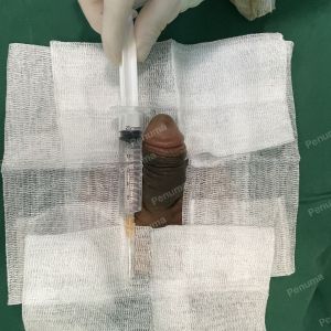 Độn dương vật bằng megaderm, đường mổ ở mu, khách hàng 40 tuổi, Ninh Bình- ca 160