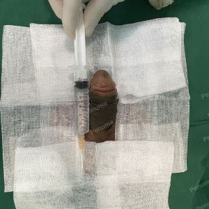 Độn dương vật bằng megaderm, đường mổ ở mu, khách hàng 40 tuổi, Ninh Bình- ca 160