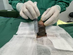 Độn dương vật bằng megaderm, đường mổ ở mu, khách hàng 40 tuổi, Ninh Bình- ca 160