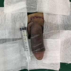 Độn dương vật bằng megaderm, đường mổ ở mu, khách hàng 40 tuổi, Ninh Bình- ca 160