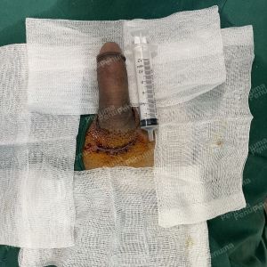 Độn dương vật bằng tấm độn sinh học, đường mổ ở mu, khách hàng 45 tuổi, Hà Nội - ca 165