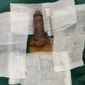 Độn dương vật bằng tấm độn sinh học, đường mổ ở mu, khách hàng 45 tuổi, Hà Nội - ca 165