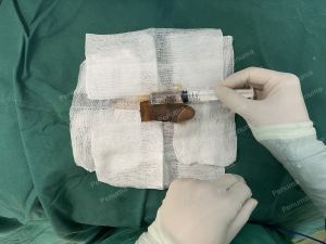 Độn dương vật bằng tấm độn sinh học, đường mổ ở mu, khách hàng 45 tuổi, Hà Nội - ca 165