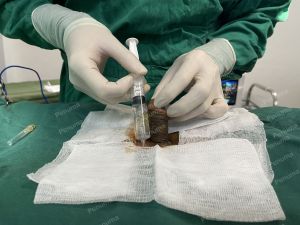 Độn dương vật bằng tấm độn sinh học, đường mổ ở mu, khách hàng 45 tuổi, Hà Nội - ca 165