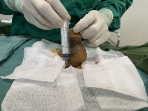 Tăng kích thước dương vật bằng tấm độn sinh học megaderm, đường mổ ở mu, khách hàng 38 tuổi, Đà Nẵng- ca 166