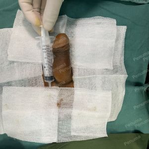 Tăng kích thước dương vật bằng tấm độn sinh học megaderm, đường mổ ở mu, khách hàng 38 tuổi, Đà Nẵng- ca 166