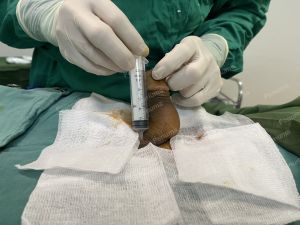 Tăng kích thước dương vật bằng tấm độn sinh học megaderm, đường mổ ở mu, khách hàng 38 tuổi, Đà Nẵng- ca 166