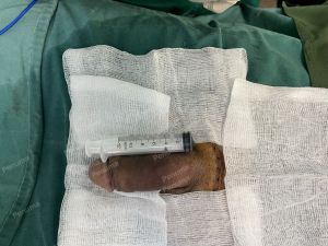 Tăng kích thước dương vật bằng tấm độn sinh học megaderm, đường mổ ở mu, khách hàng 38 tuổi, Đà Nẵng- ca 166