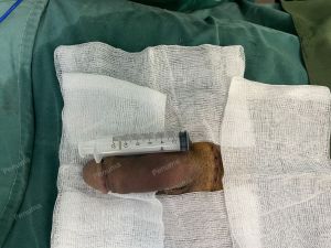 Tăng kích thước dương vật bằng tấm độn sinh học megaderm, đường mổ ở mu, khách hàng 38 tuổi, Đà Nẵng- ca 166