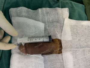 Tăng kích thước dương vật bằng tấm độn sinh học megaderm, đường mổ ở mu, khách hàng 38 tuổi, Đà Nẵng- ca 166