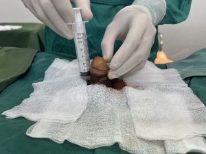 Tăng kích thước dương vật bằng tấm độn sinh học megaderm, đường mổ ở mu, khách hàng 35 tuổi, Hưng Yên - ca 167
