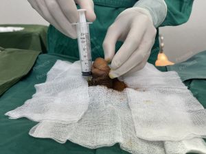 Tăng kích thước dương vật bằng tấm độn sinh học megaderm, đường mổ ở mu, khách hàng 35 tuổi, Hưng Yên - ca 167