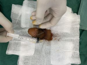 Tăng kích thước dương vật bằng tấm độn sinh học megaderm, đường mổ ở mu, khách hàng 35 tuổi, Hưng Yên - ca 167