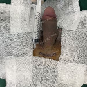 Tăng kích thước dương vật bằng tấm độn sinh học megaderm, đường mổ ở mu, khách hàng 35 tuổi, Hưng Yên - ca 167