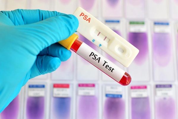 Vai trò của xét nghiệm PSA trong chẩn đoán ung thư tuyến tiền liệt