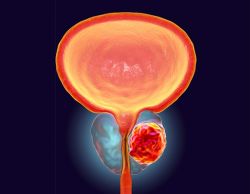 Ung thư tuyến tiền liệt kháng cắt tinh hoàn là gì và điều trị bằng cách nào?