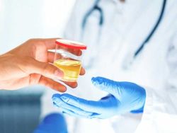 Xét nghiệm PCA3 trong chẩn đoán ung thư tuyến tiền liệt