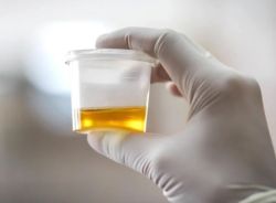 Nồng độ axit uric trong nước tiểu bao nhiêu là bình thường?