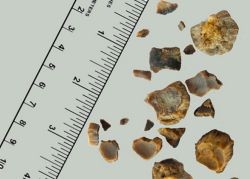 Có những loại sỏi thận nào và cách điều trị có khác nhau không?