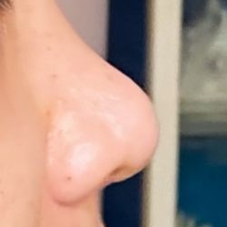 Xin chào ạ, em nâng mũi cấu trúc lấy sụn tại bọc đầu mũi (mũi trước của em khá thô to đầu mũi, da dày và nhờn nhiều tuy nhiên sau nâng cải thiện rất nhiều được thấy rõ lúc vừa phẫu thuật xong). Hôm nay là ngày thứ 40, đa phần sóng mũi đã gom nhưng ph