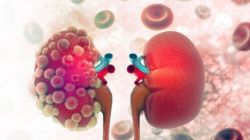 Nang Thận Có Trở Thành Ung Thư Thận Không?