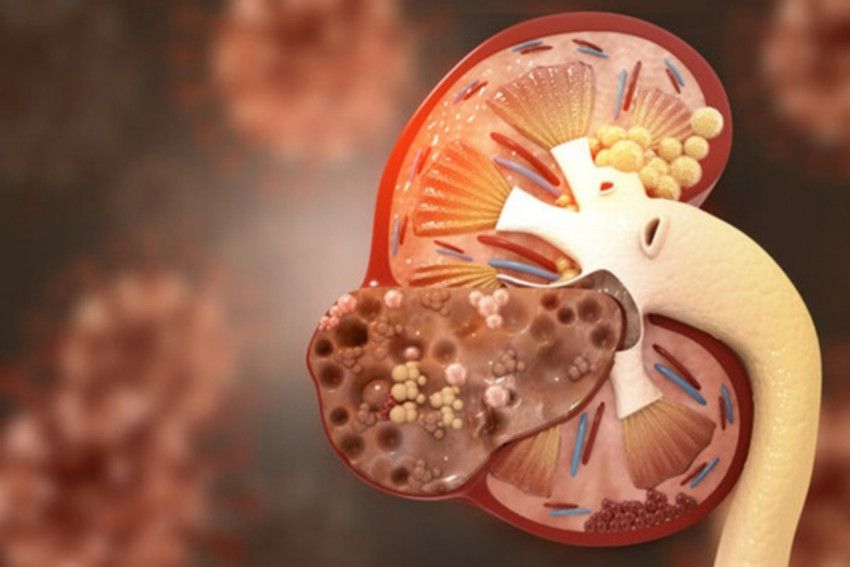 Ung Thư Biểu Mô Tế Bào Thận Giai Đoạn Cuối: Tiên Lượng Và Các Phương Pháp Điều Trị