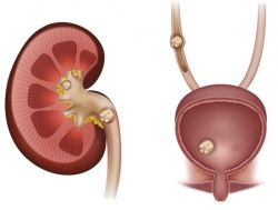 Giãn đài bể thận có nguy hiểm không? Điều trị bằng cách nào?