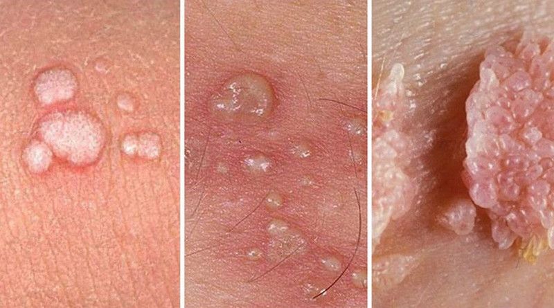 Ai có thể bị nhiễm HPV và HVS