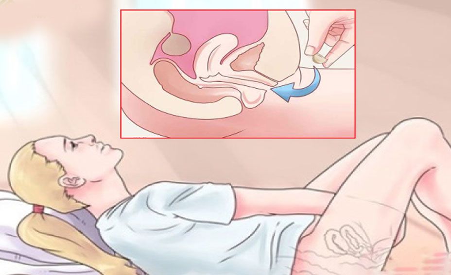 bao cao su bi ket trong am dao