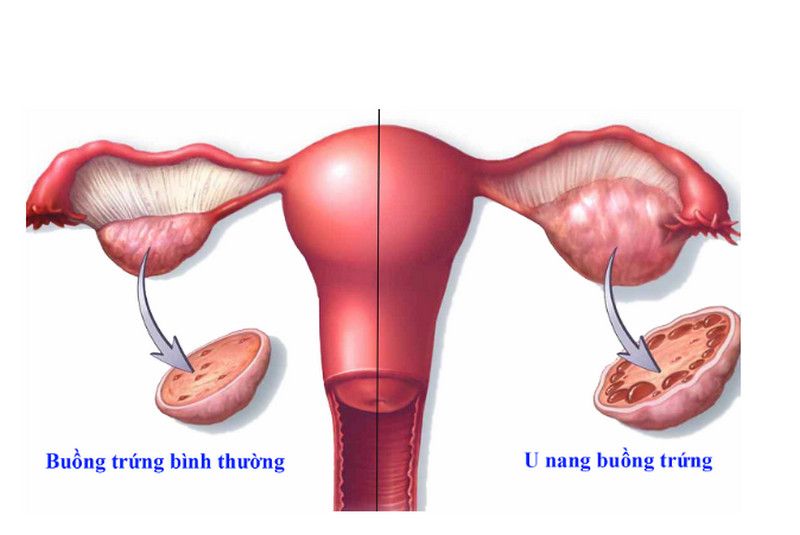 bi u nang buong trung co quan he tinh duc duoc khong