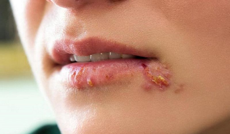 Biểu hiện của bệnh giang mai