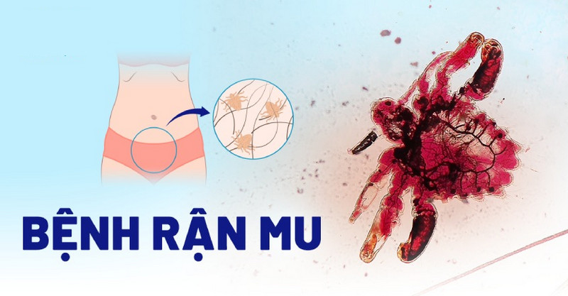 Cách trị rận mu