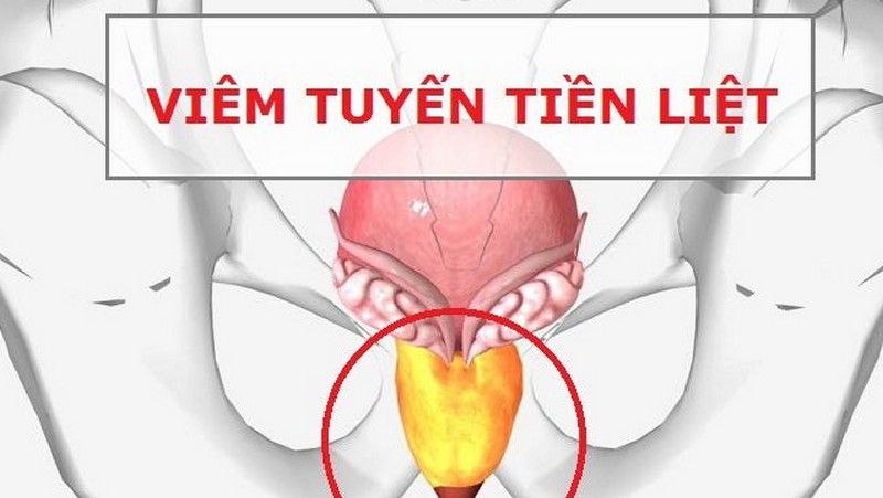 Nóng dương vật gây viêm tuyến tiền liệt