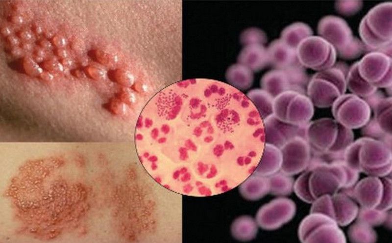 Các triệu chứng thường gặp của STI