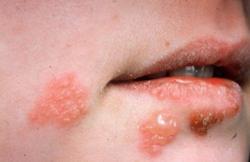 Bệnh Herpes
