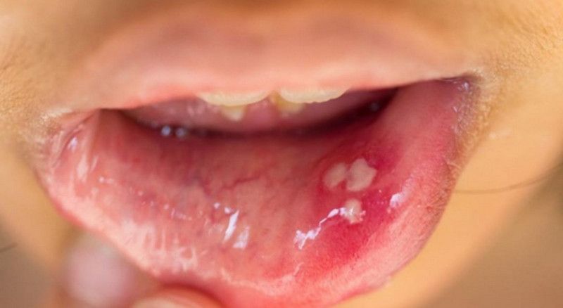 Người bệnh nhiễm HPV