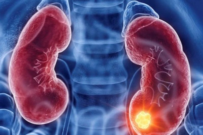 Dấu hiệu nhận biết sớm của ung thư thận