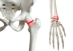 Người bị loãng xương có nguy cơ gãy những xương nào?