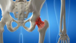 Loãng xương hông thoáng qua: Nguyên nhân và cách điều trị