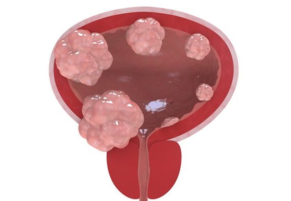 Ung thư bàng quang xâm lấn cơ: Triệu chứng, điều trị và tiên lượng