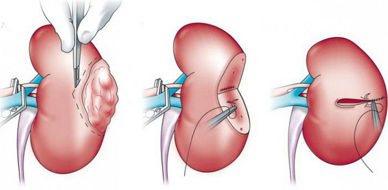 Phân Biệt phẫu thuật cắt thận