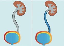 Trào ngược bàng quang - niệu quản điều trị bằng cách nào?