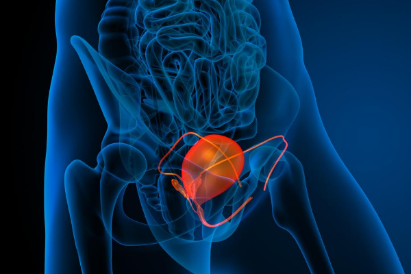 Ung thư bàng quang lan có nhanh không?