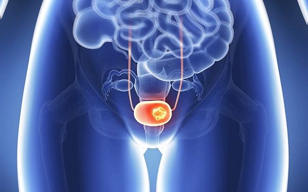 Ung thư bàng quang: Triệu chứng, điều trị và tiên lượng