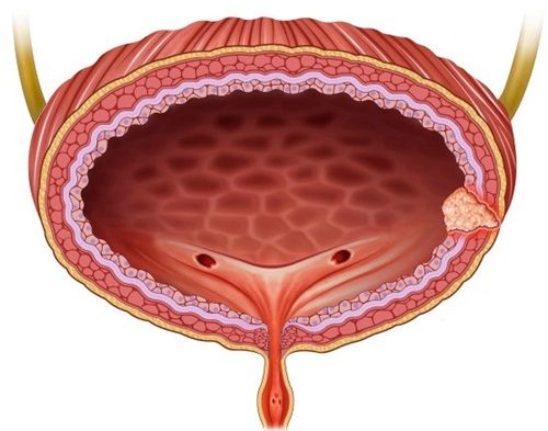 Viêm tam giác bàng quang có triệu chứng gì?