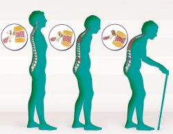 Giải đáp các thắc mắc thường gặp về chứng loãng xương sau mãn kinh