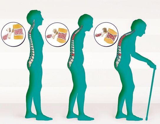 Giải đáp các thắc mắc thường gặp về chứng loãng xương sau mãn kinh