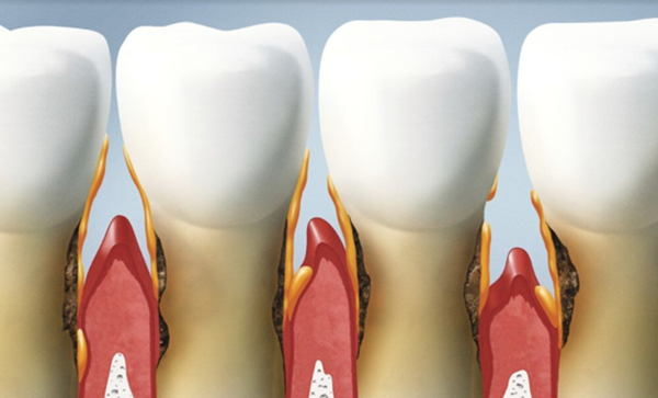 Loãng xương có ảnh hưởng đến răng không?