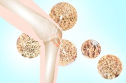 Loãng xương có ngăn ngừa được không?